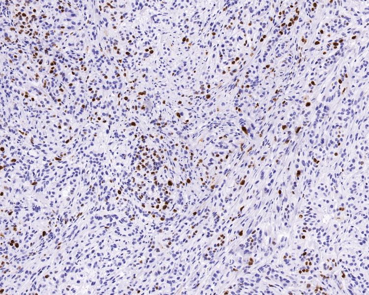 免疫組化染色主圖